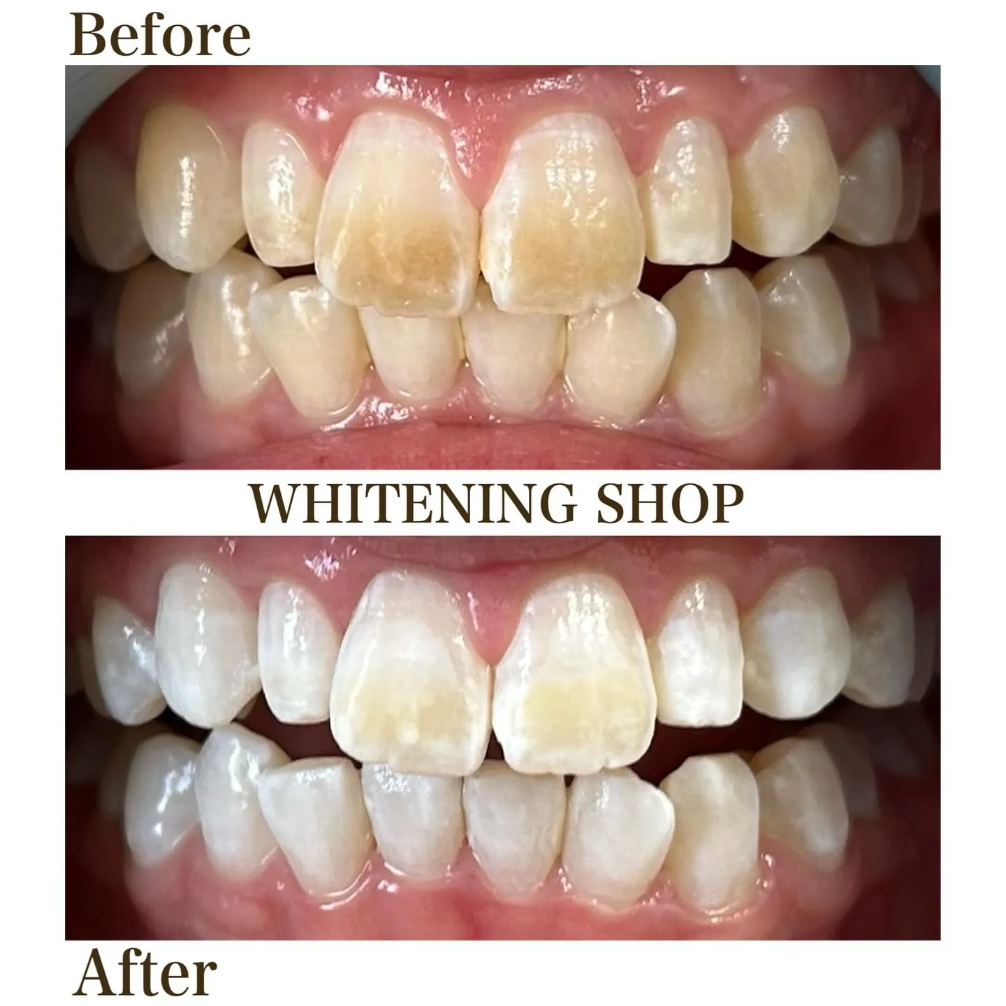 🦷❄️＼冬の“ホワイトシーズン”到来！／❄️🦷