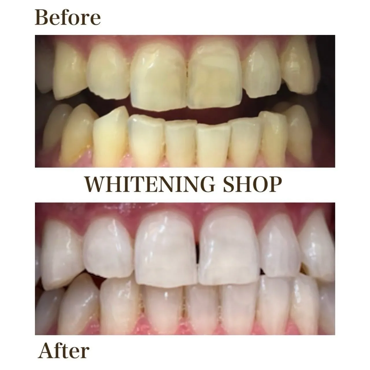 🦷💫＼笑顔がもっと輝く、自然な白さへ／💫🦷