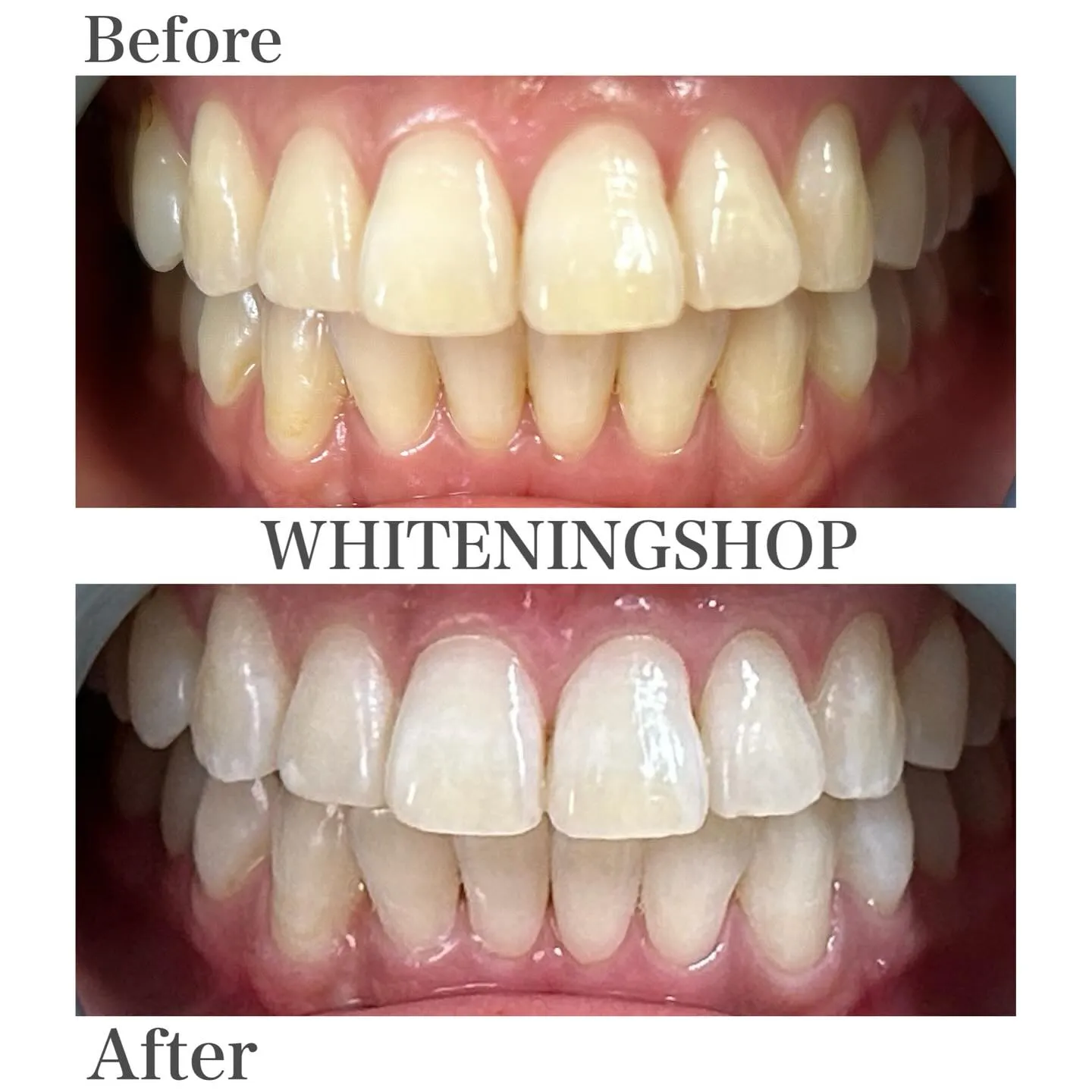我慢しない、続けられるホワイトニング🦷✨