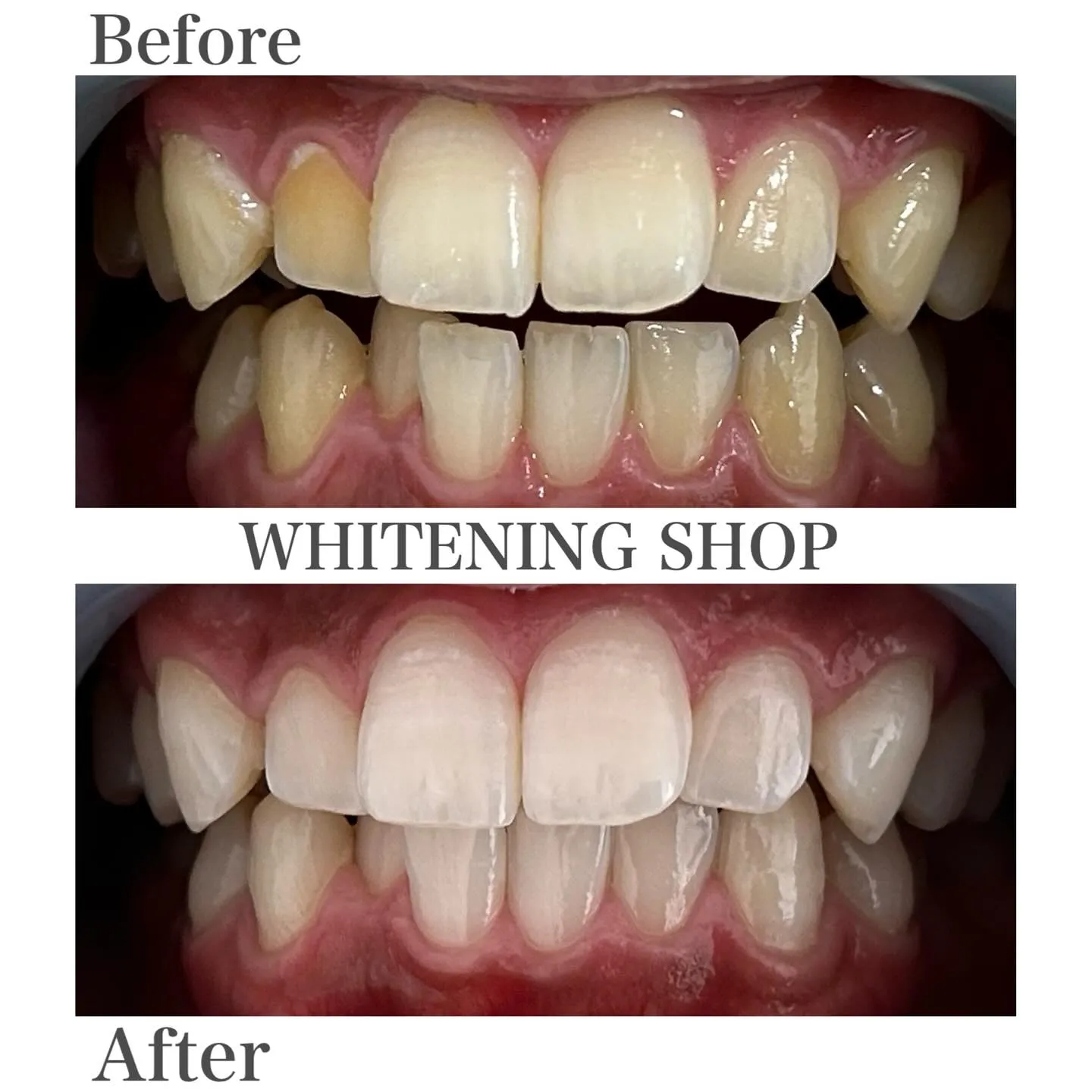 ホットドリンクの季節、歯の白さ大丈夫？☕️