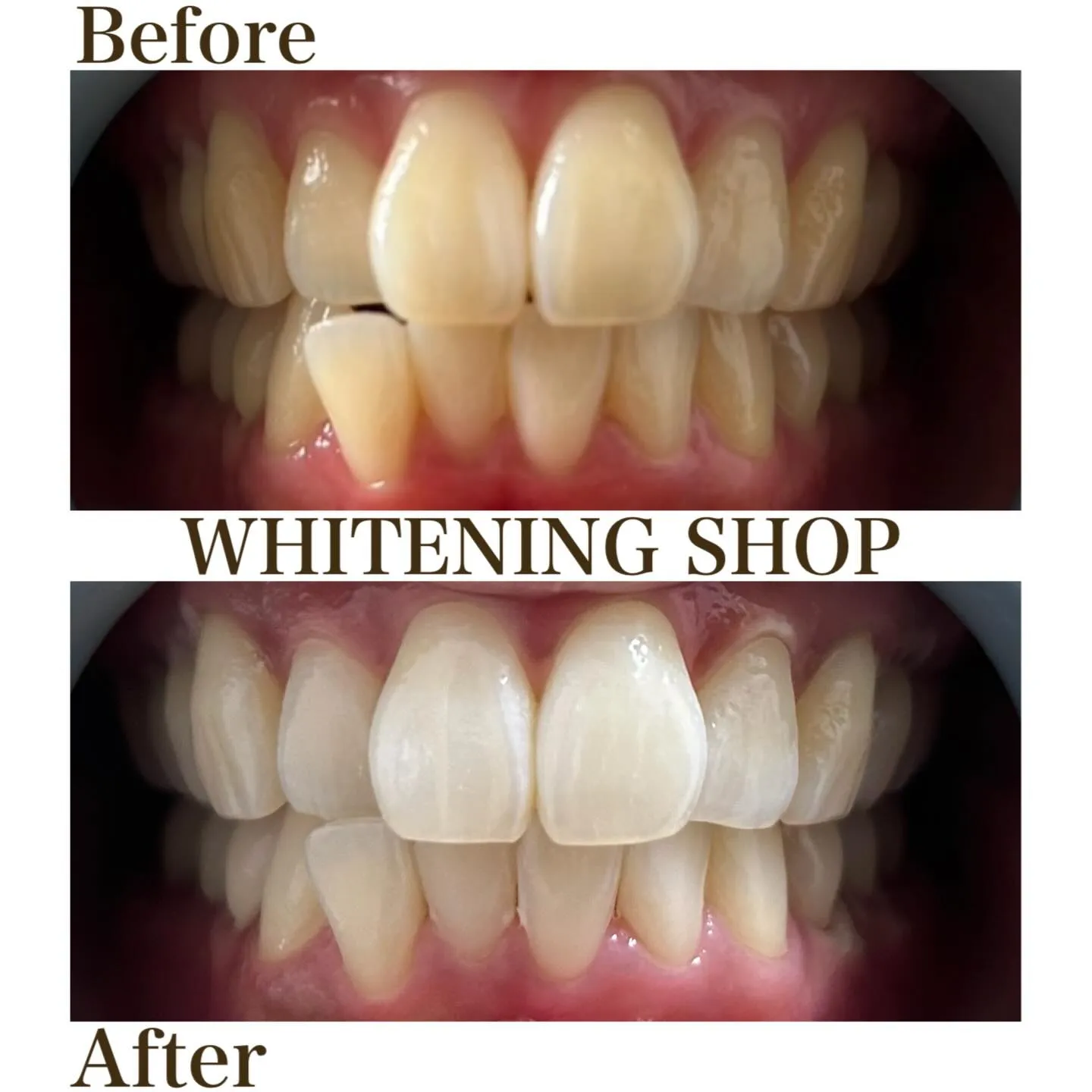 美容の抜けポイント=歯のケア🦷