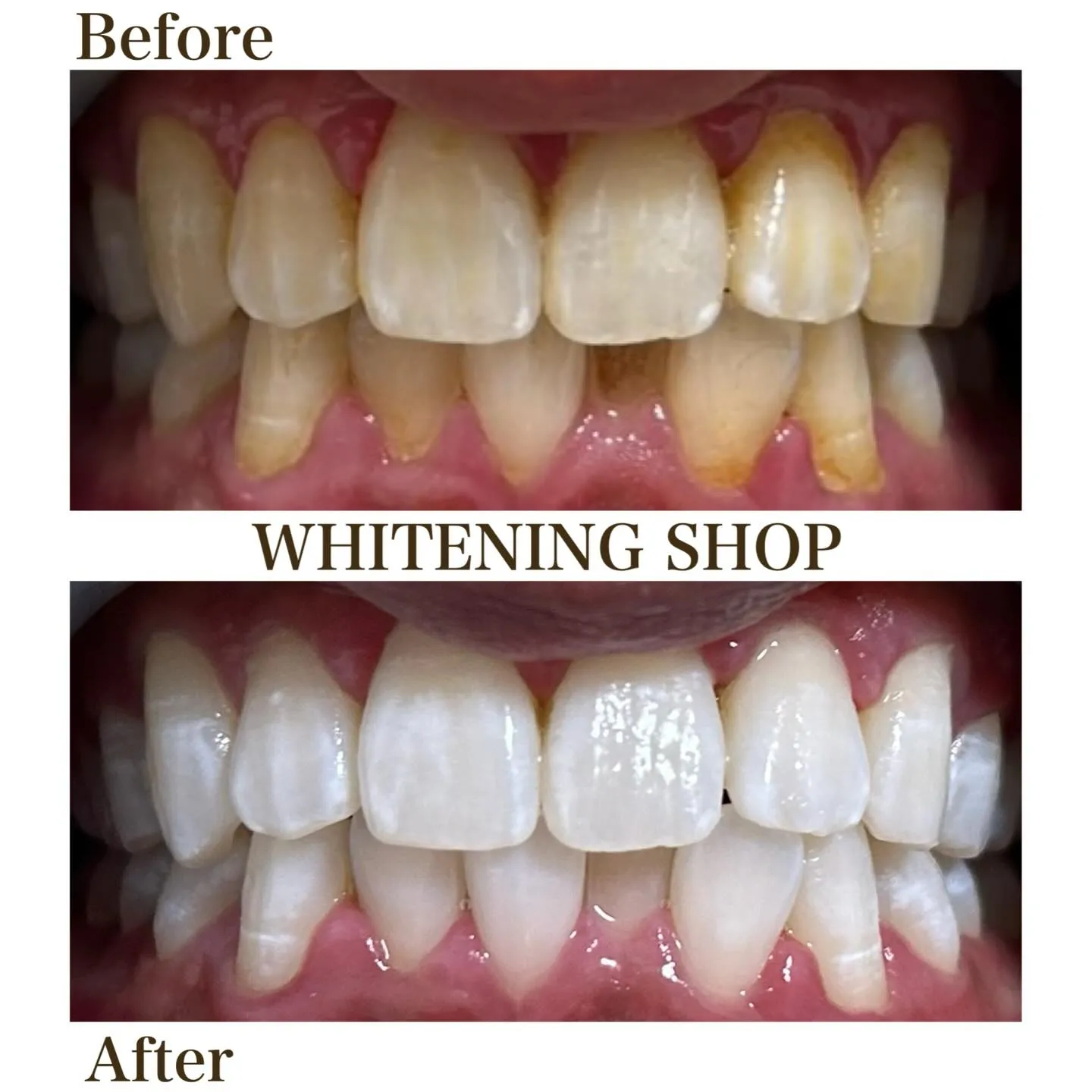 笑顔に、ひとつ自信を足すホワイトニング✨