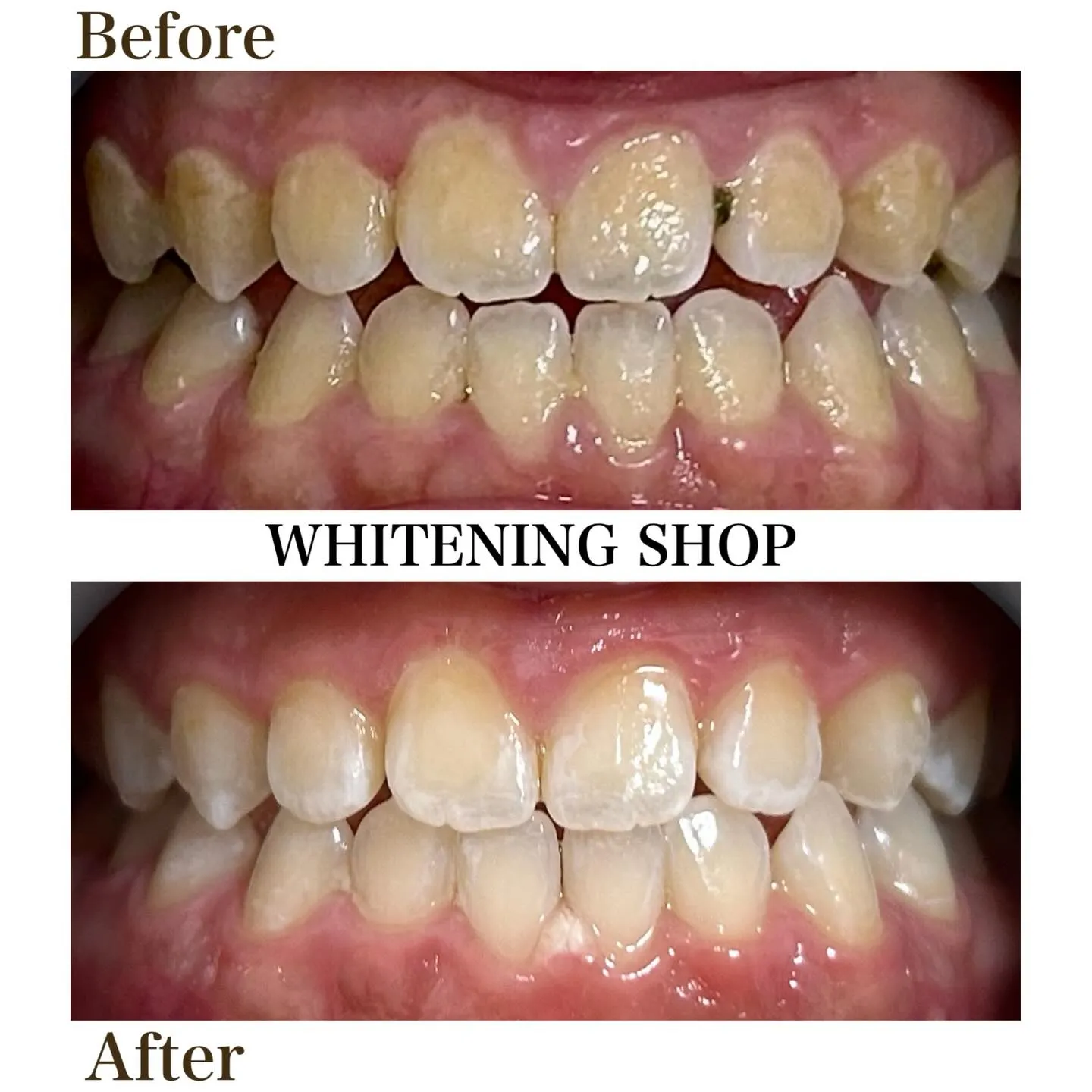 笑顔の印象をぐっと格上げ。