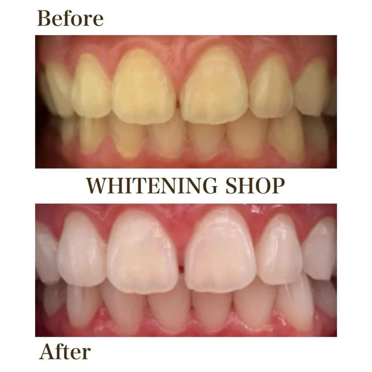 はじめてのホワイトニング、ここから🦷✨