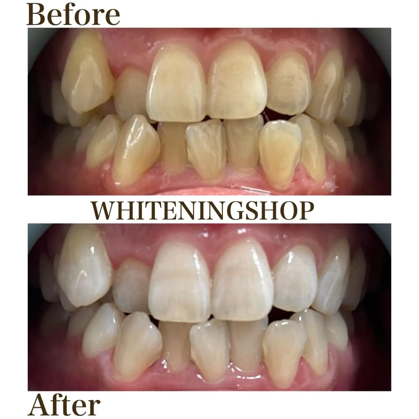 🦷✨＼ 歯のツヤ、失われていませんか？ ／✨🦷