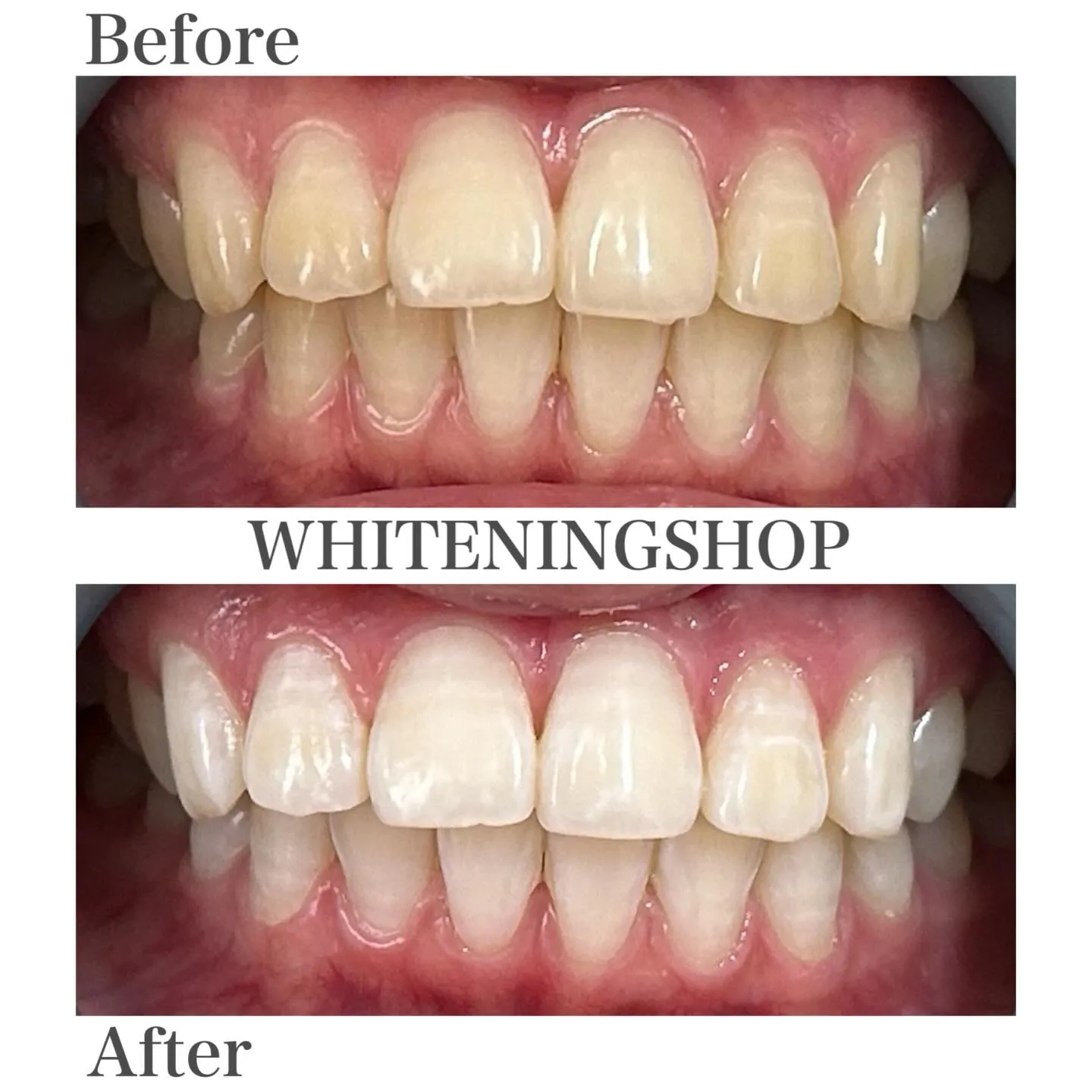 🌸春目前、口元の透明感もアップデートしませんか?🦷✨