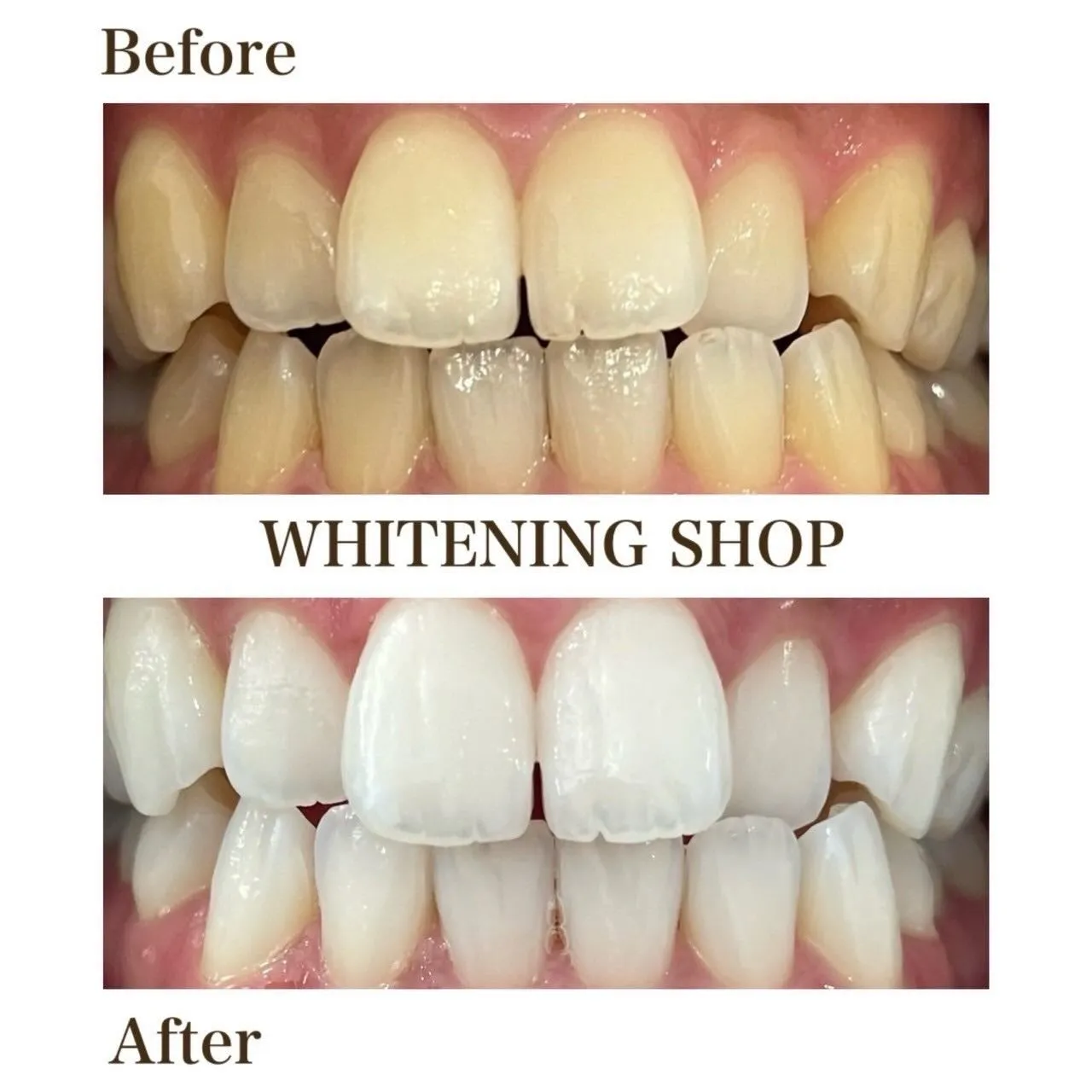 はじめてでも安心🕊️やさしいホワイトニング体験✨