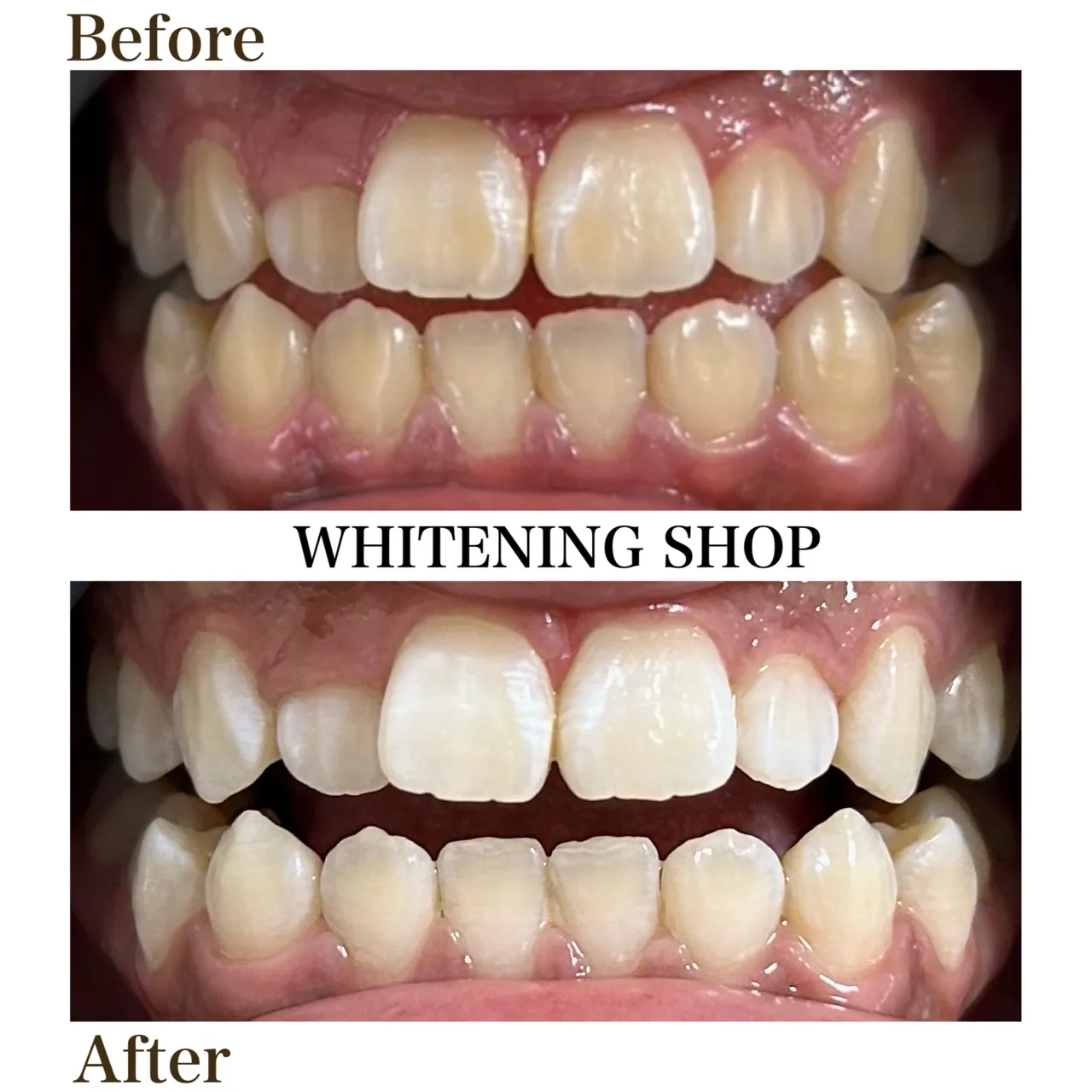 その歯のくすみ、見慣れてませんか？🦷