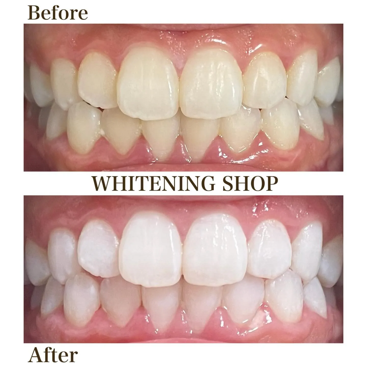 笑った瞬間の印象を左右する、口元の美しさ。