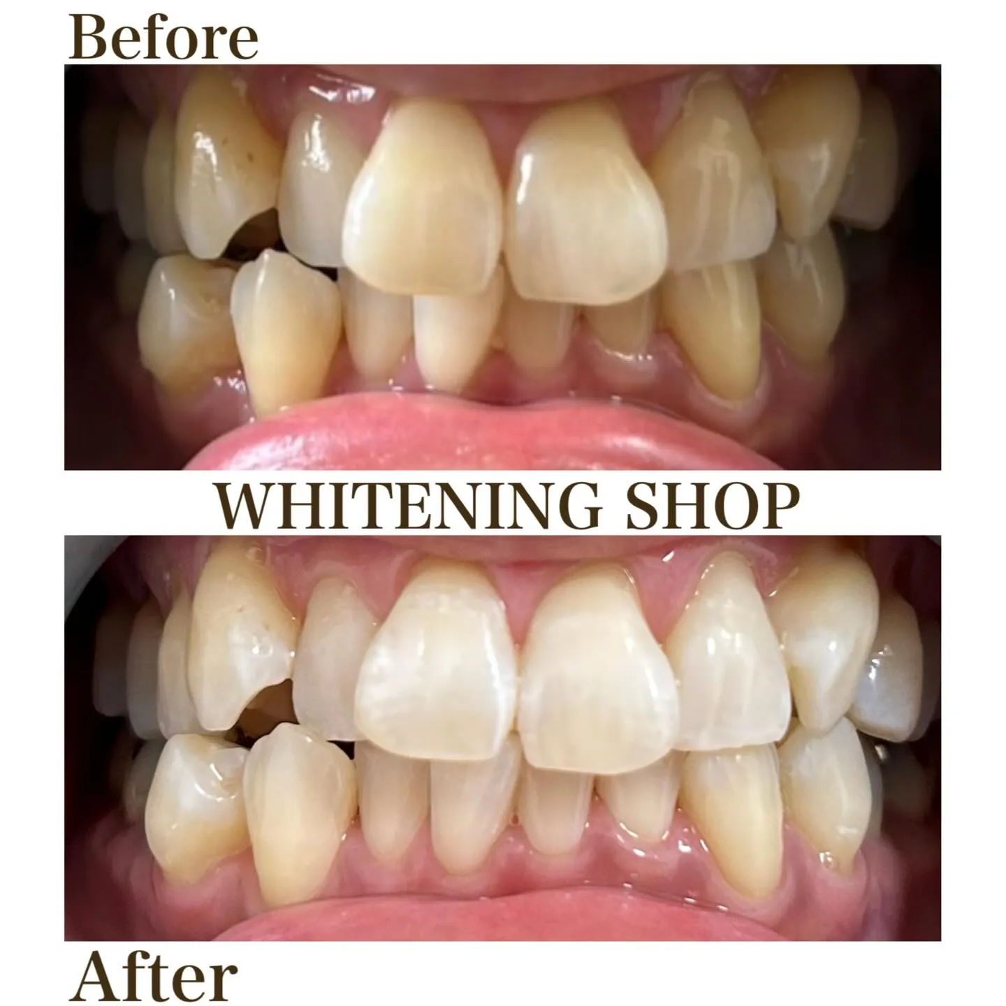 ホワイトニング、気になってはいるけどまだ始めていない方へ✨