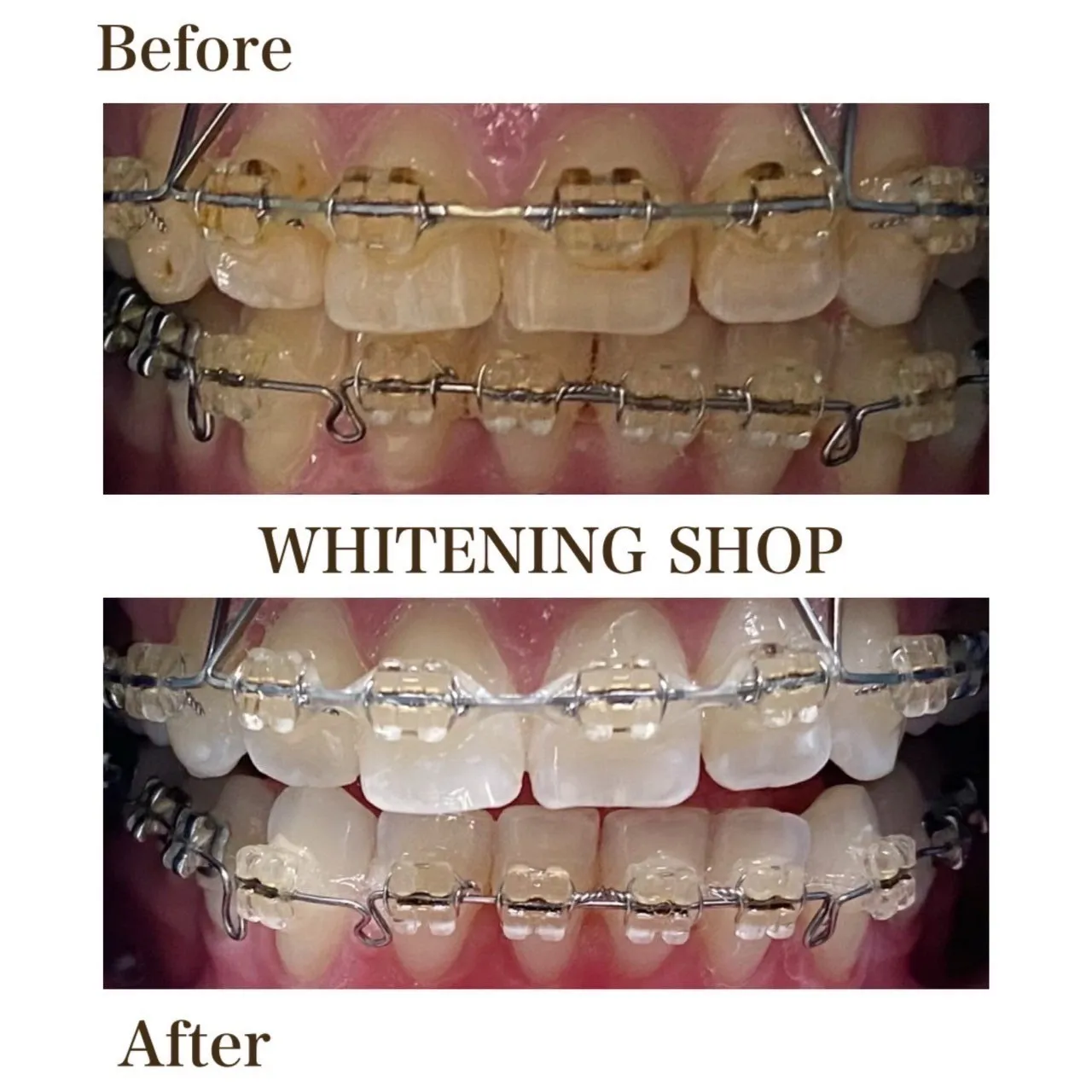 🦷✨矯正中でもホワイトニングできるって知っていますか?✨🦷
