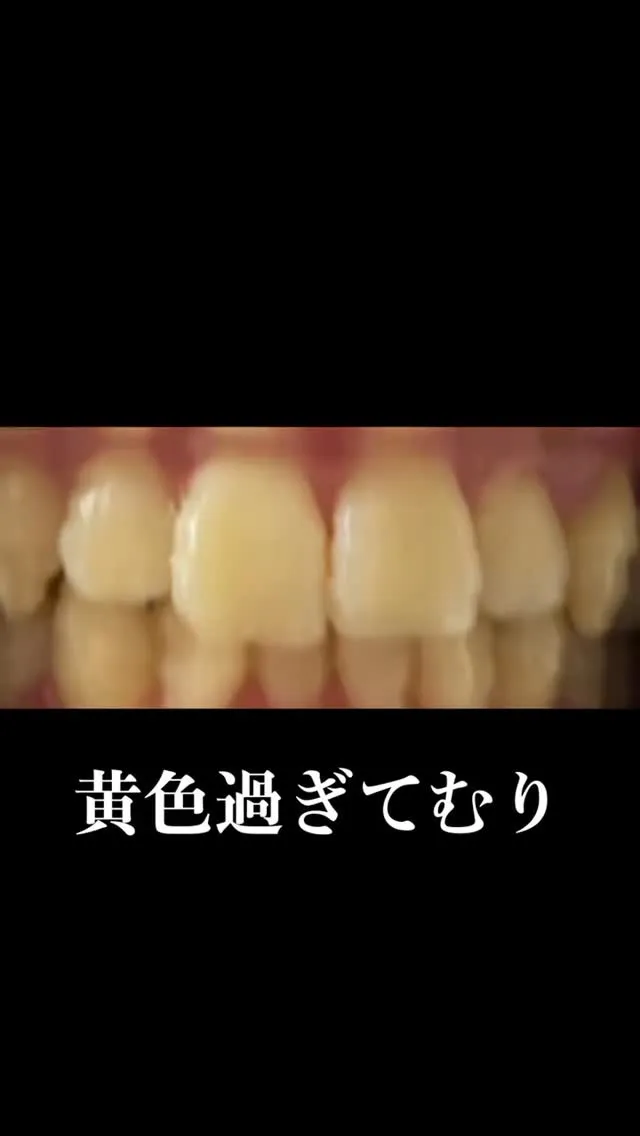 黄ばみが気になる時期にホワイトニングでトーンアップ！